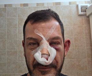 Massacrato in casa sua da due immigrati, ridotto così – FOTO
