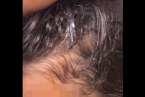 Ronde islamiche attaccano donne senza velo a Ravenna: bambina di 12 anni sfigurata con l’acido