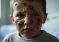 Bambino italiano massacrato a bastonate da tre bambini stranieri: faccia distrutta